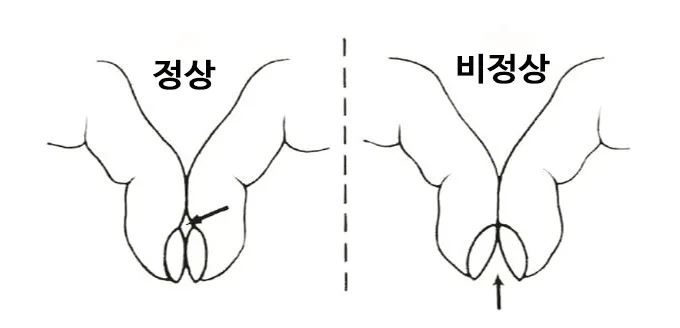  폐암의 가능성이 있는지 미리 진단을 할 수 있는 간단한 손가락 테스트가 있다. 바로 '샴로트의 창문 테스트(Schamroth's window)'이다. 양 검지 손톱을 맞대어서 다이아몬드 형태가 보이면 정상이고 안 보이면 폐암의 가능성이 있음을 알려준다.